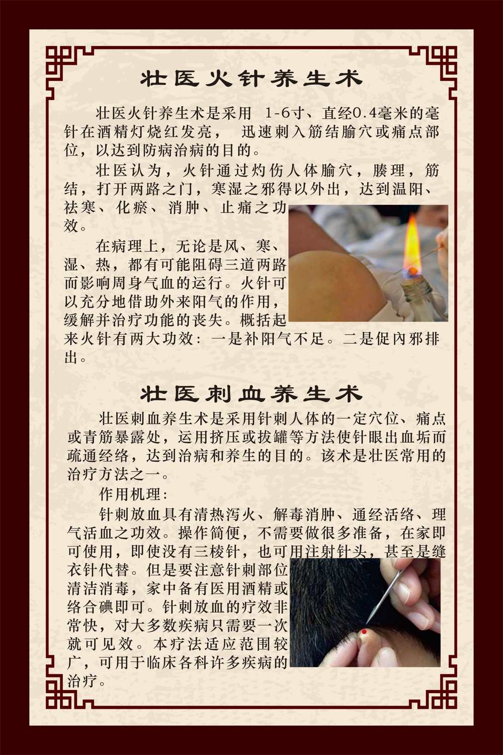 火针刺血